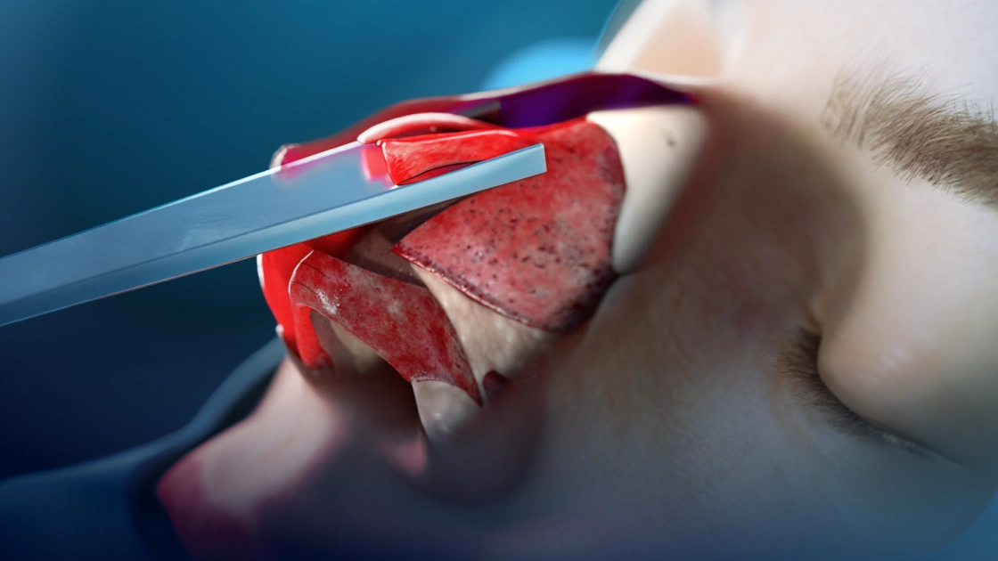 Остеотомия и скульптурирование верхушки