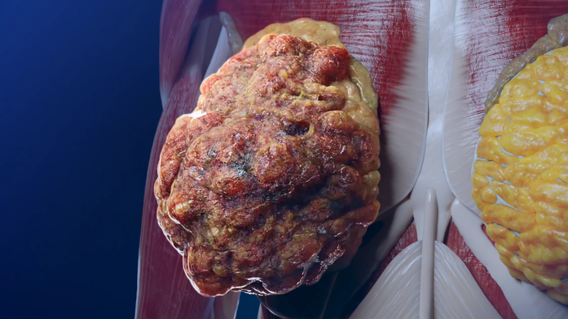 Invasive Lobular Carcinoma