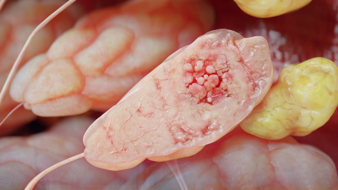 Lobular carcinoma in situ