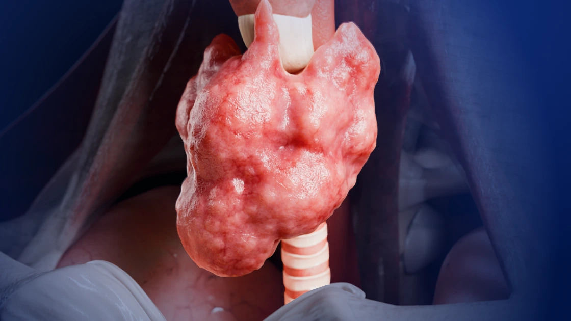 Multinodular Goiter Explained