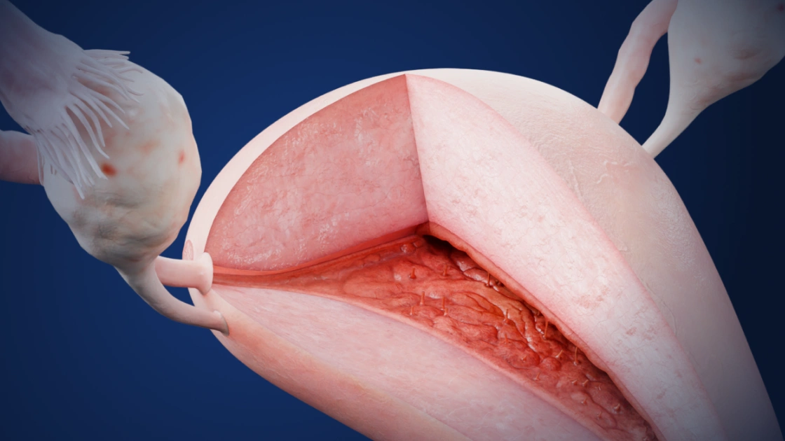 Tuberculous endometritis