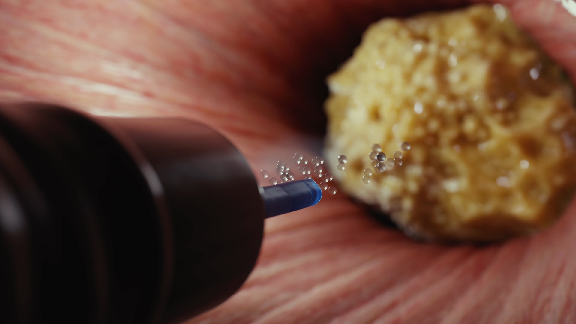 Ureteroscopy