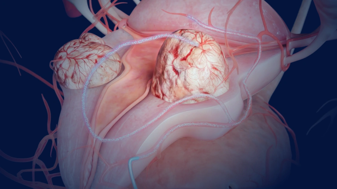Uterine artery embolization