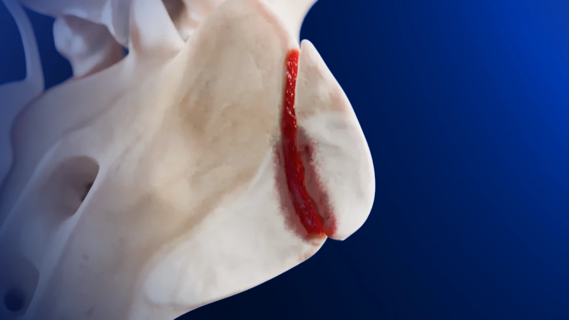 Zona 1 Sacral Fracture