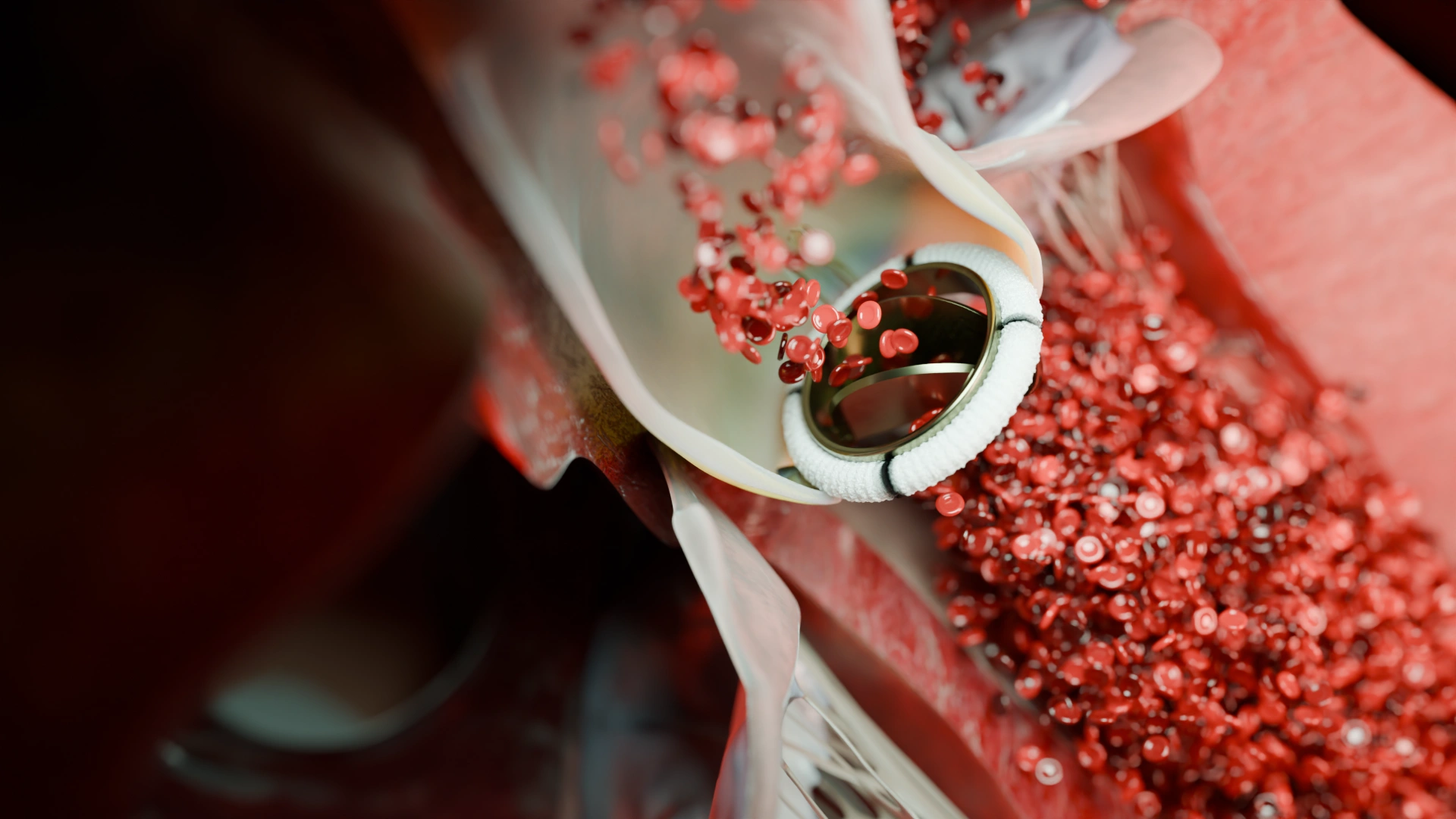 A 3D medical animation showing a prosthetic aortic valve implanted within the vessel, with red blood cells flowing freely through the open valve leaflets, illustrating restored hemodynamic function.
