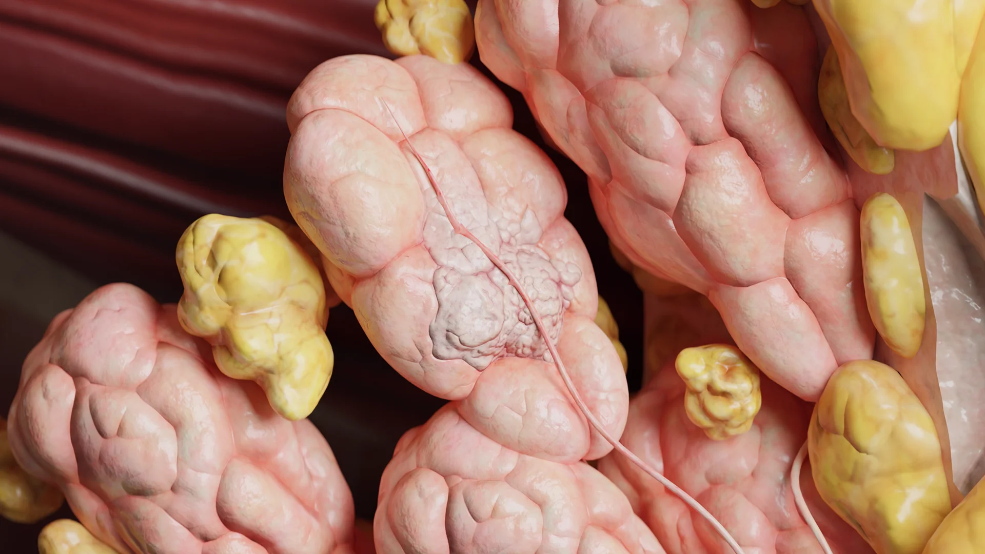 A medical 3D rendering of lobular carcinoma in situ (LCIS), visualizing the abnormal proliferation of cells within the milk-producing glands of the breast tissue.