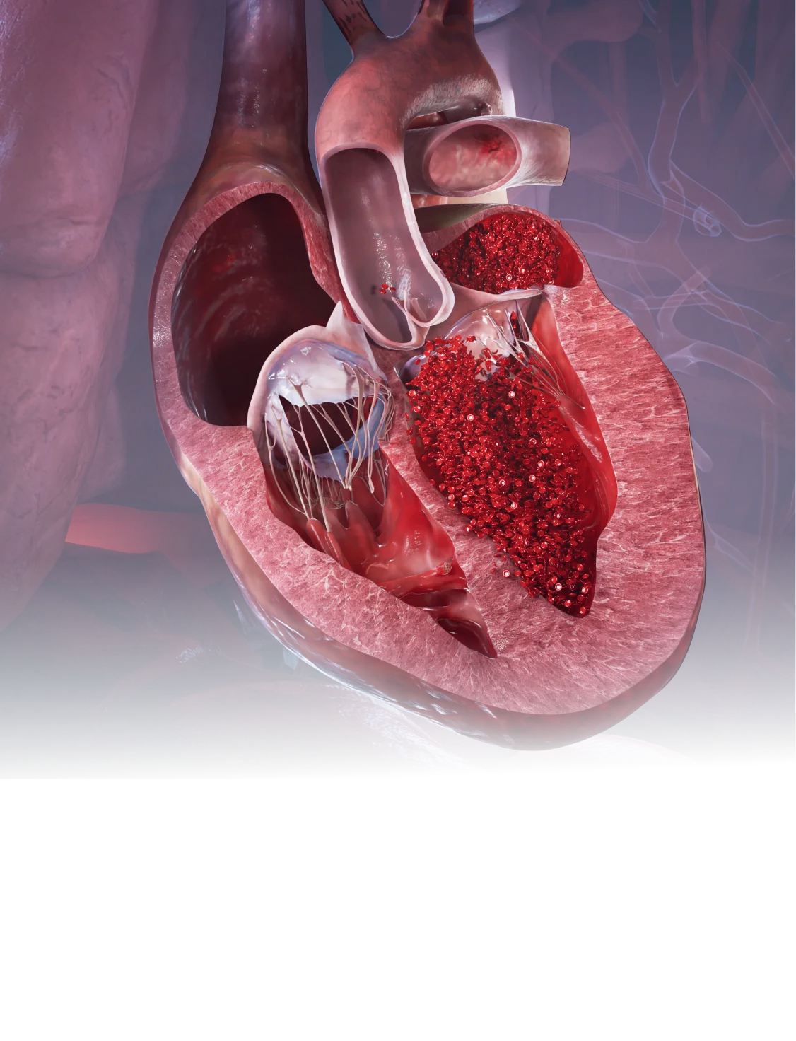 A detailed pathology render of a human heart cross-section revealing a large blood clot, representing the visualization of diseased organs and pathological changes.