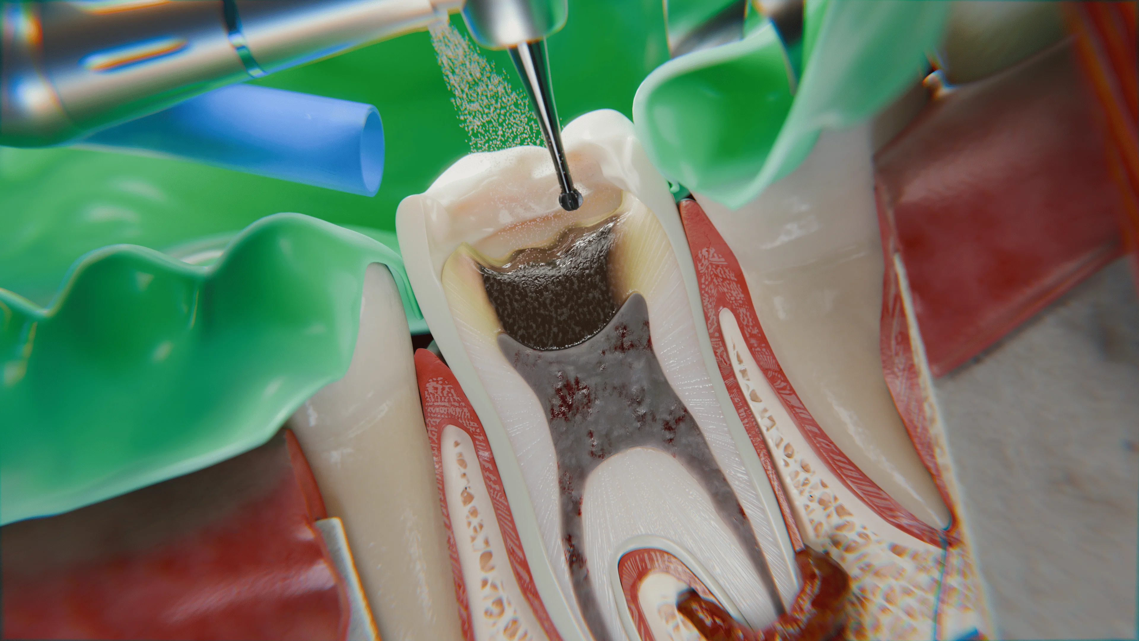 A cross-sectional view of a tooth during a root canal treatment, showing a dental drill removing infected pulp tissue from the pulp chamber and root canals.