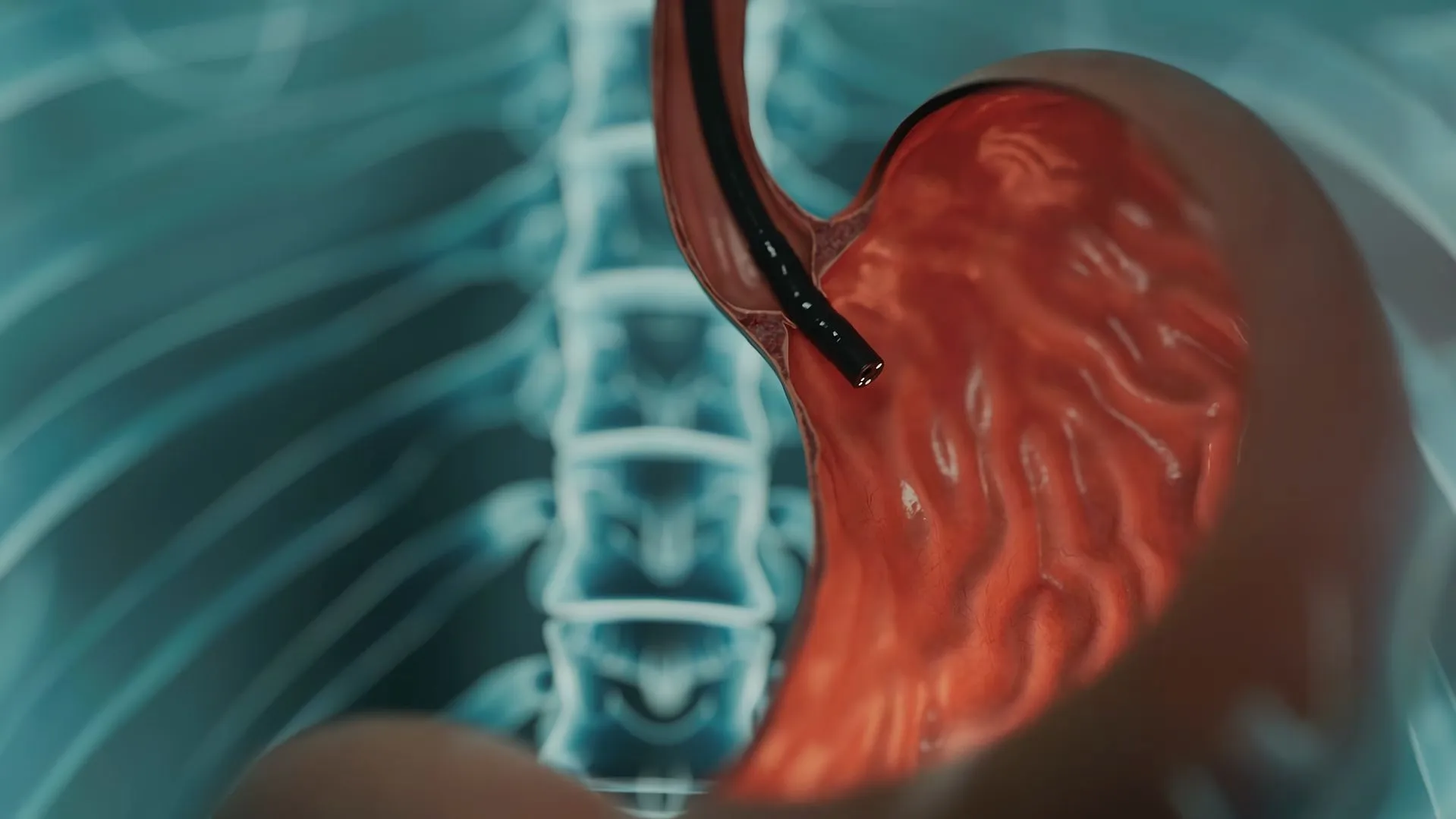 Endoscopic hemostasis