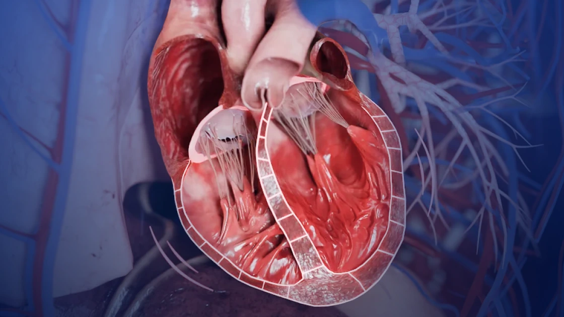 Dilatative kardiomyopathie