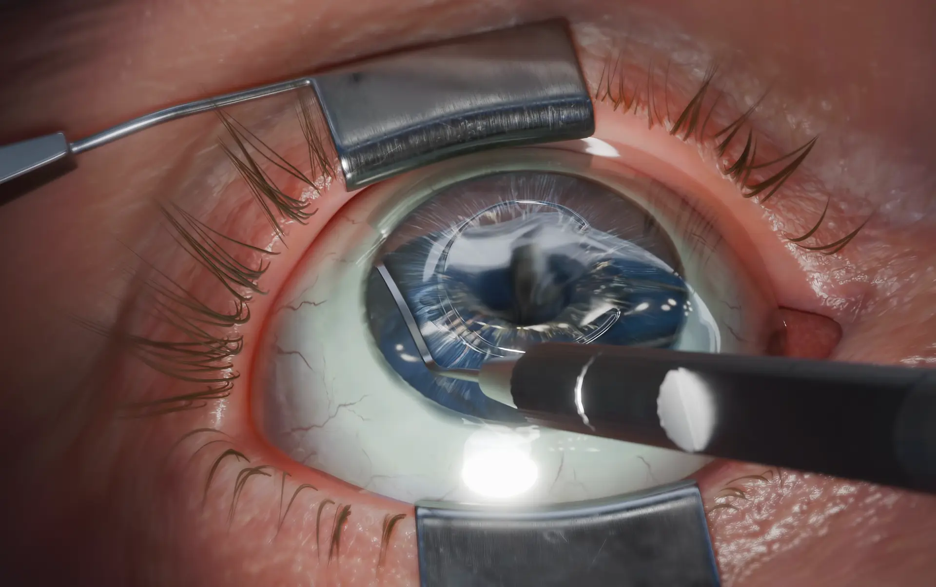 Laser vision correction