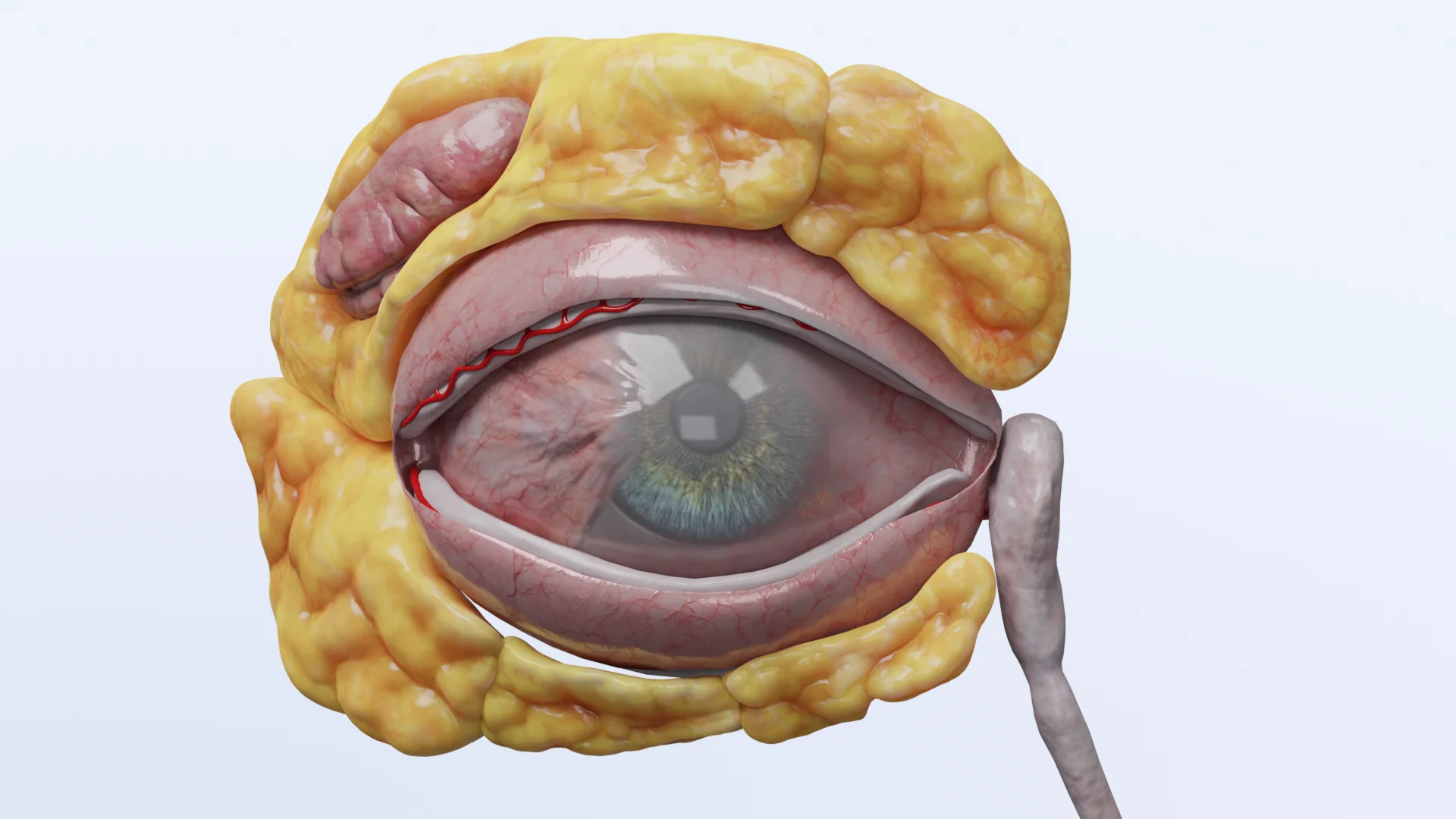 Pterygium: Ätiologie, Grad, Diagnose, Behandlung