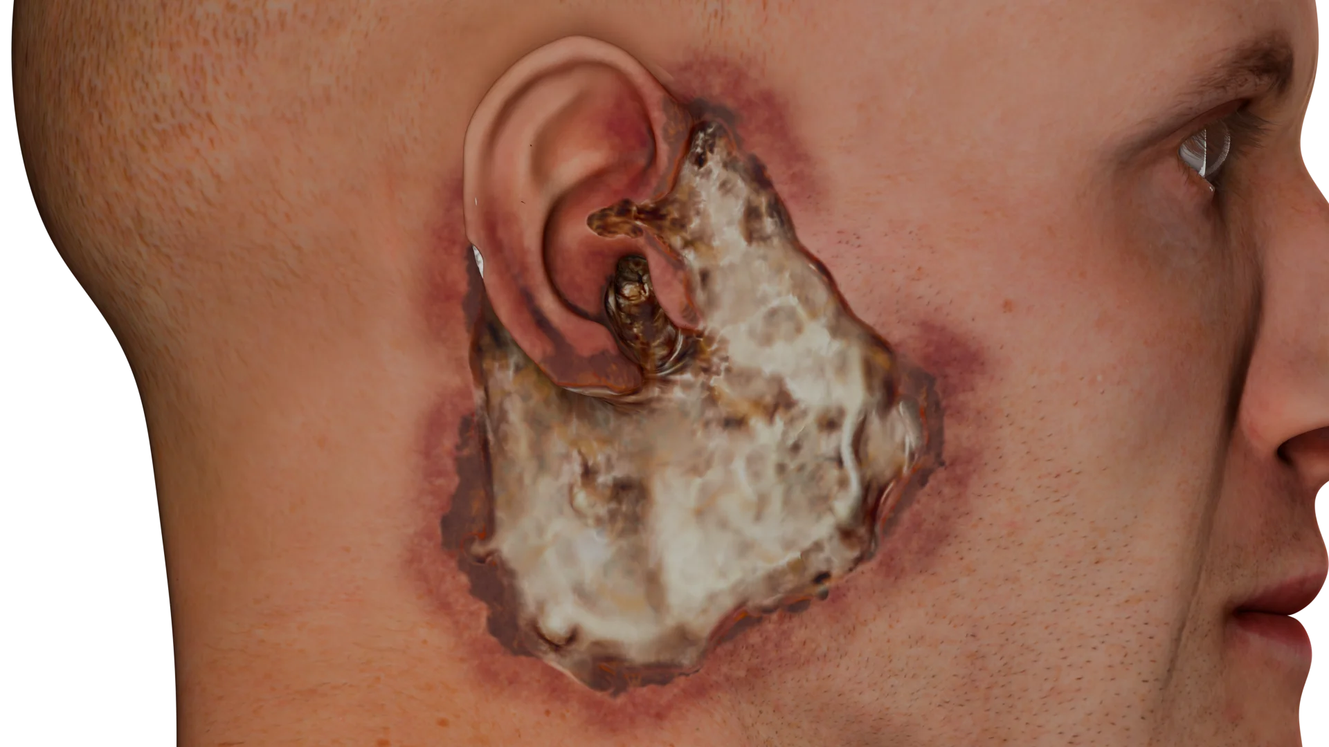 Enfermedades infecciosas del conducto auditivo externo: Síntomas, diagnóstico y tratamiento de la otitis externa