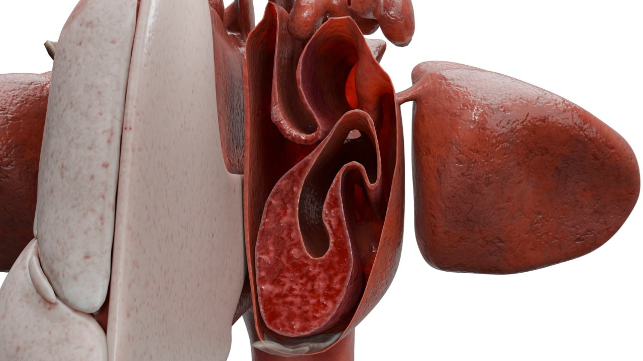Vasomotorische Rhinitis (Nasenmuscheln im Schnitt)