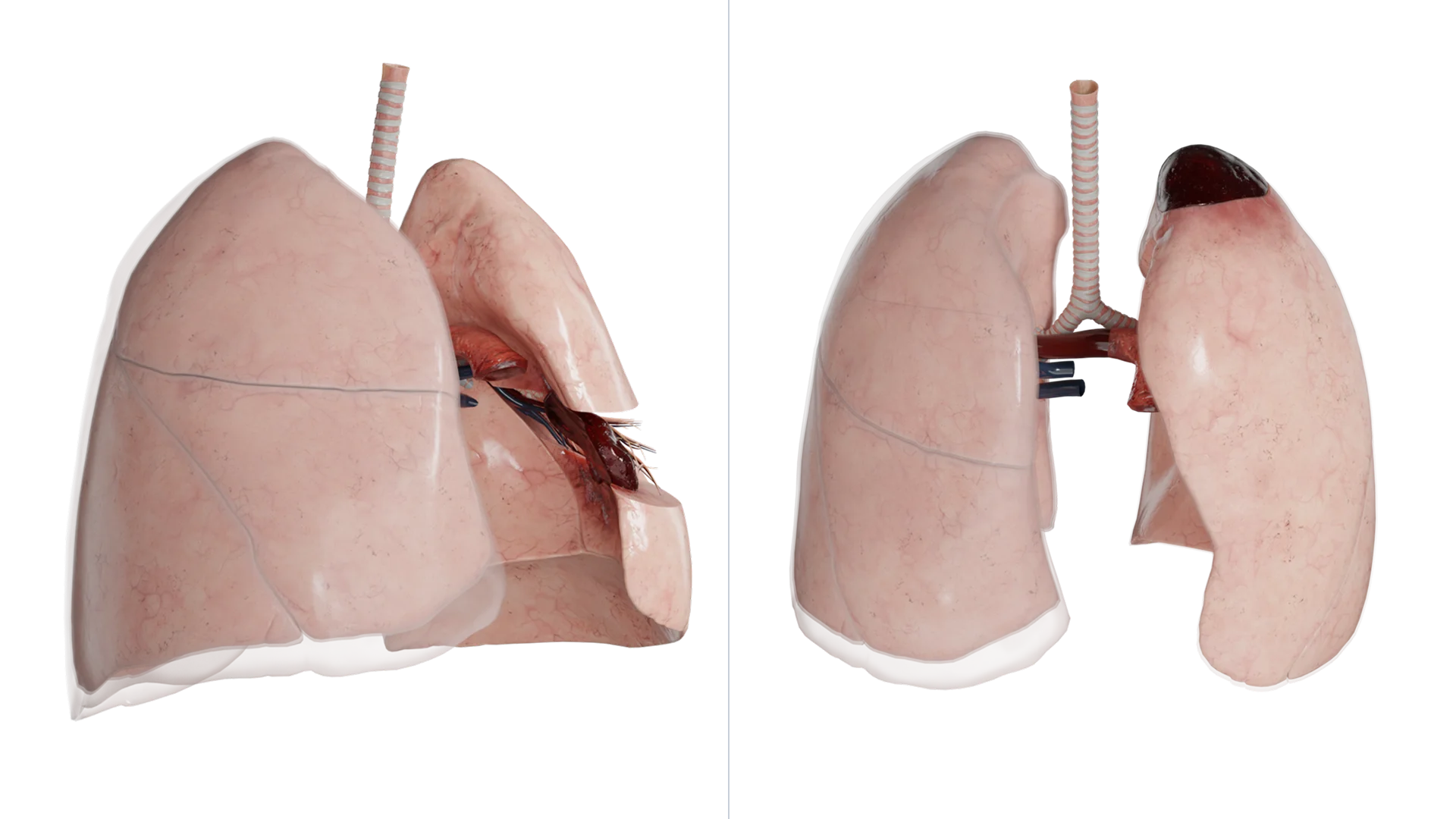 Pneumothorax apical gauche localisé avec du sang enkysté