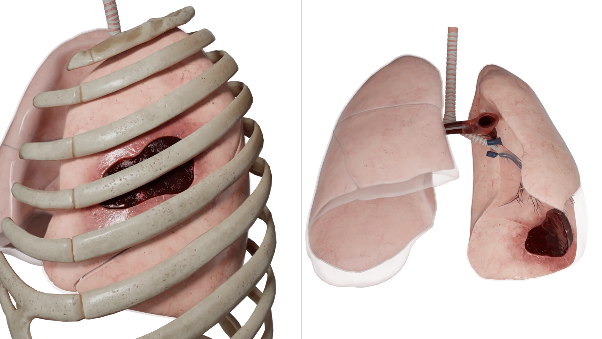 Hémothorax gauche localisé