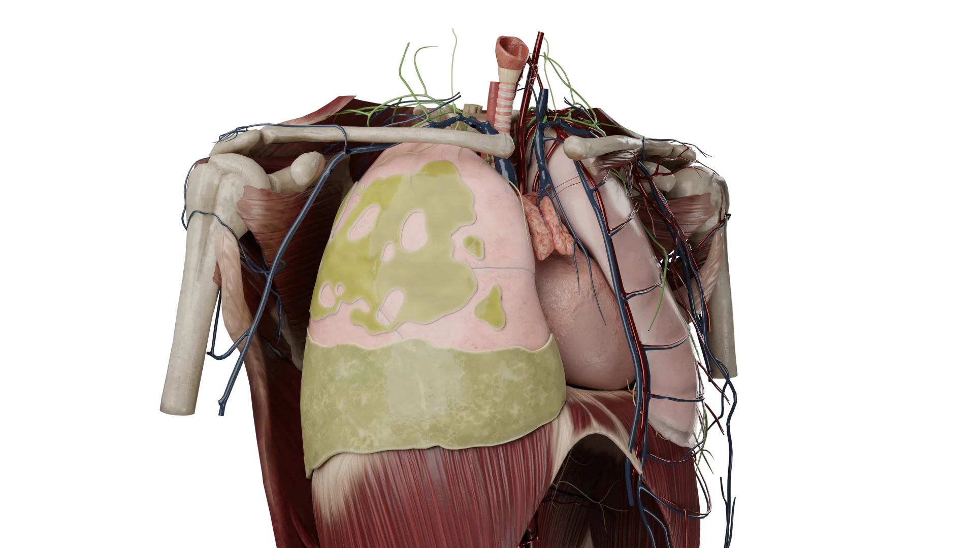 Pneumothorax droit infecté (pyothorax)