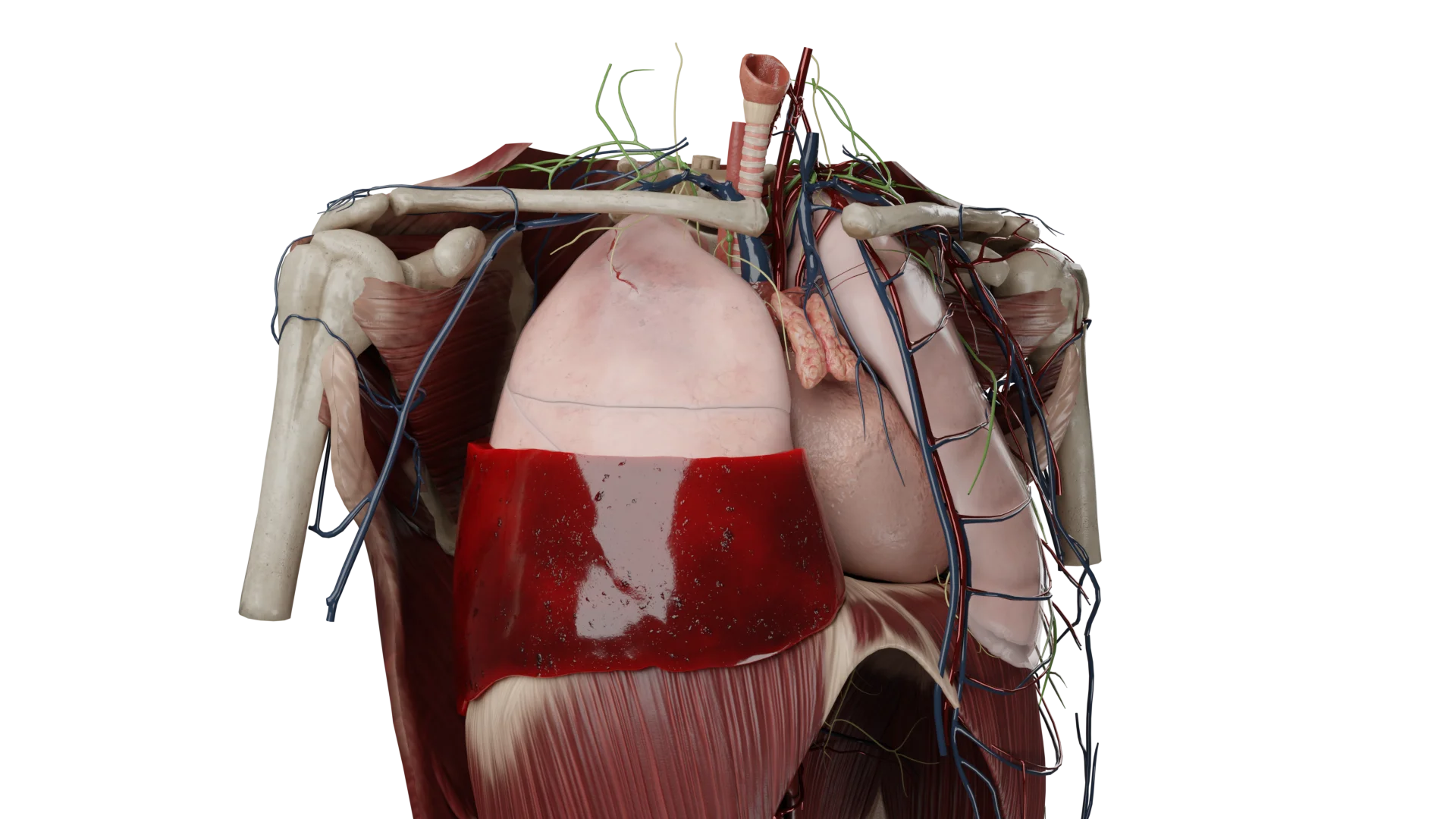 Hémopneumothorax droit