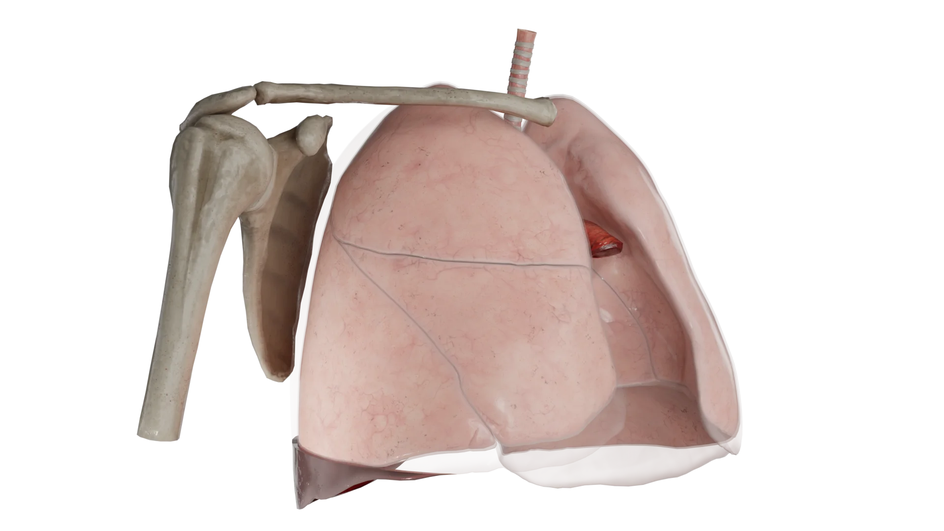 Hémopneumothorax bilatéral de petite abondance