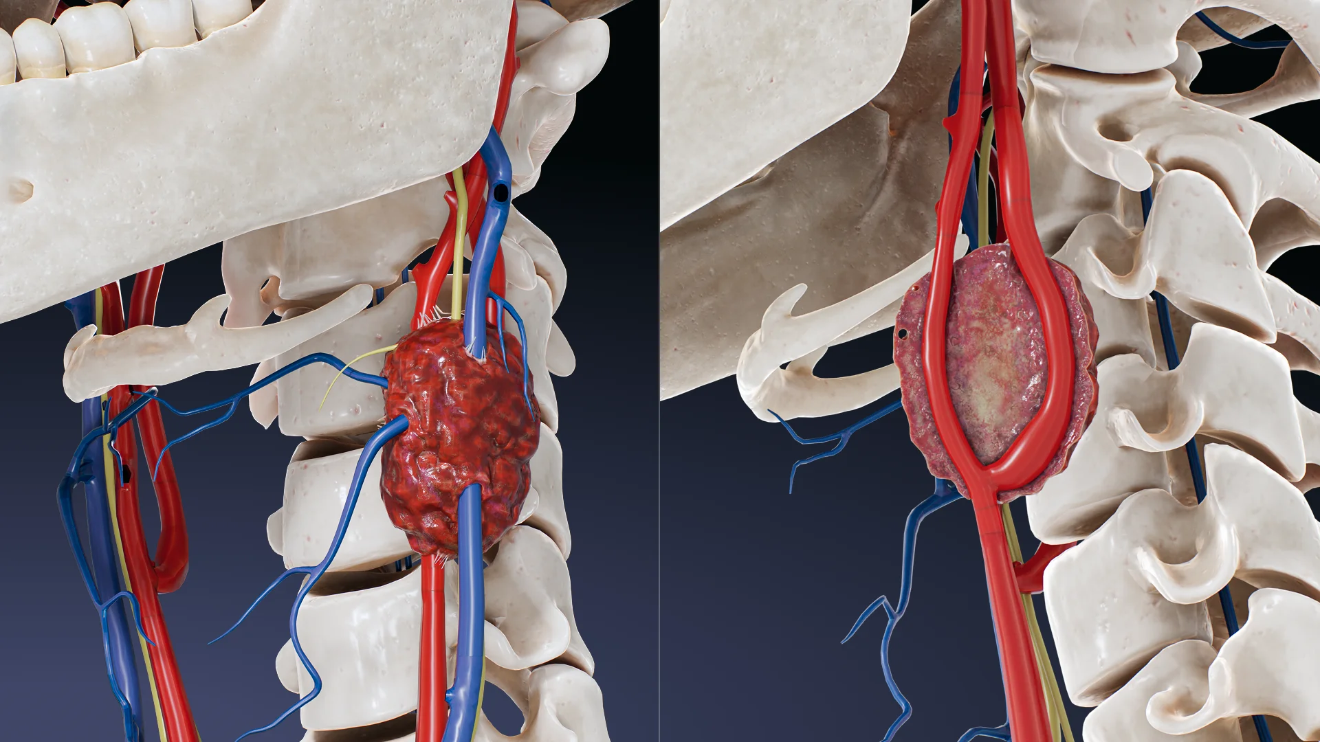 Glomus-caroticum-Paragangliom, Typ II