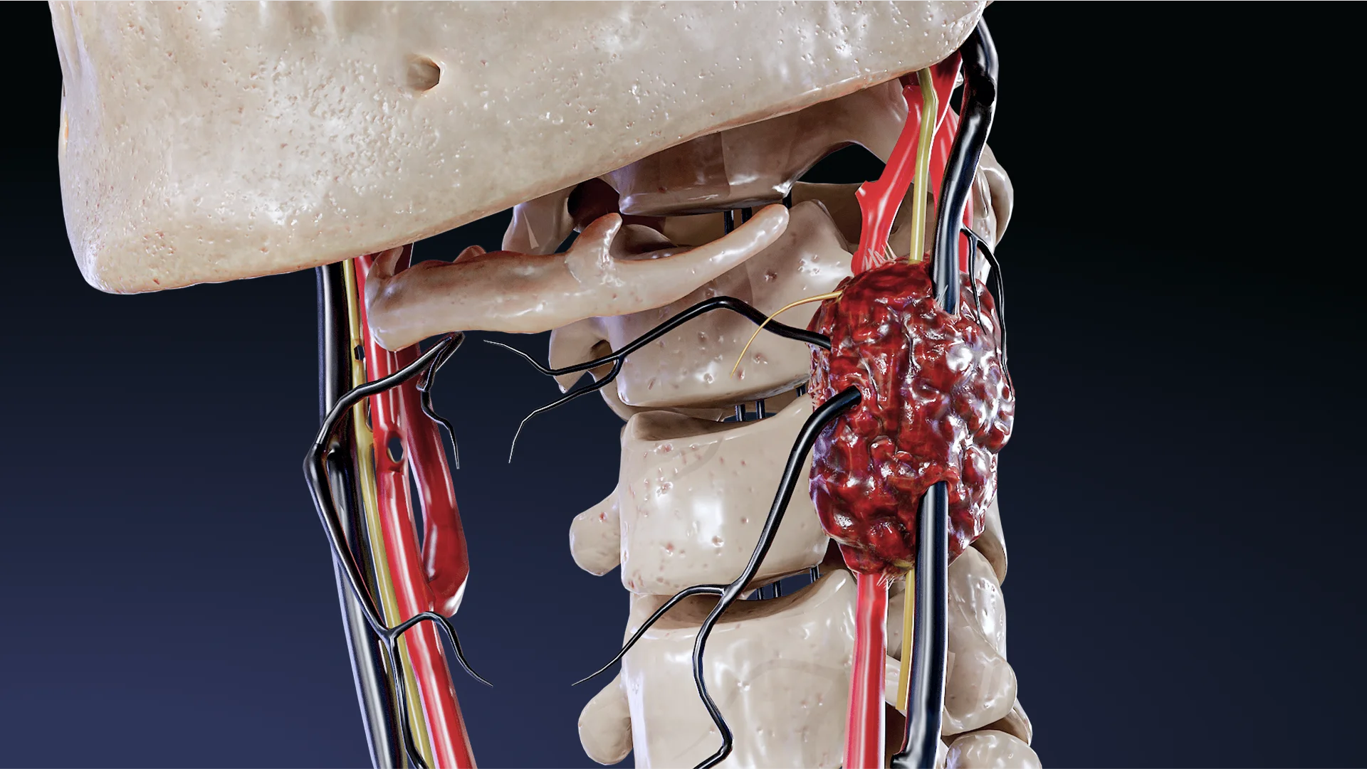 Chémodectome (paragangliome) : étiologie, pathogénie, classification, diagnostic, méthodes de traitement