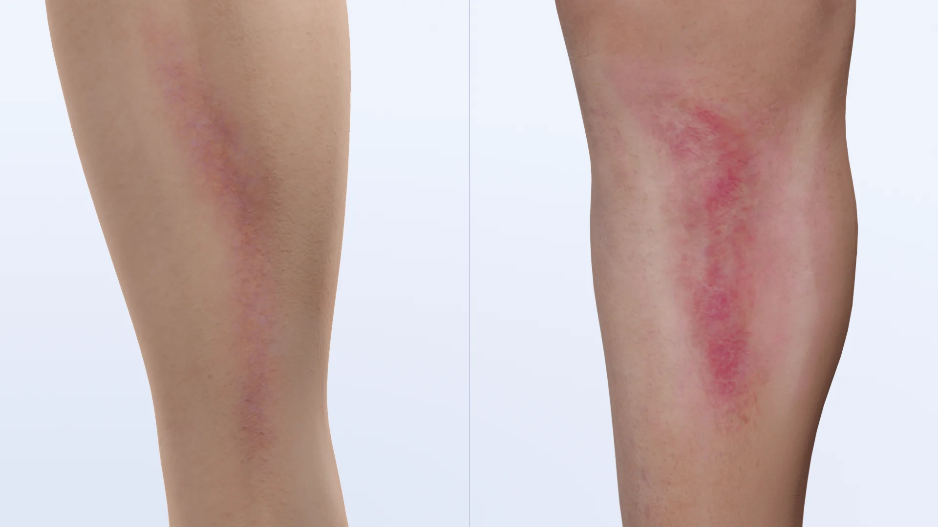 Lokale Erscheinungsformen der Thrombophlebitis (oberflächliche Venen des Unterarms und des Unterschenkels)