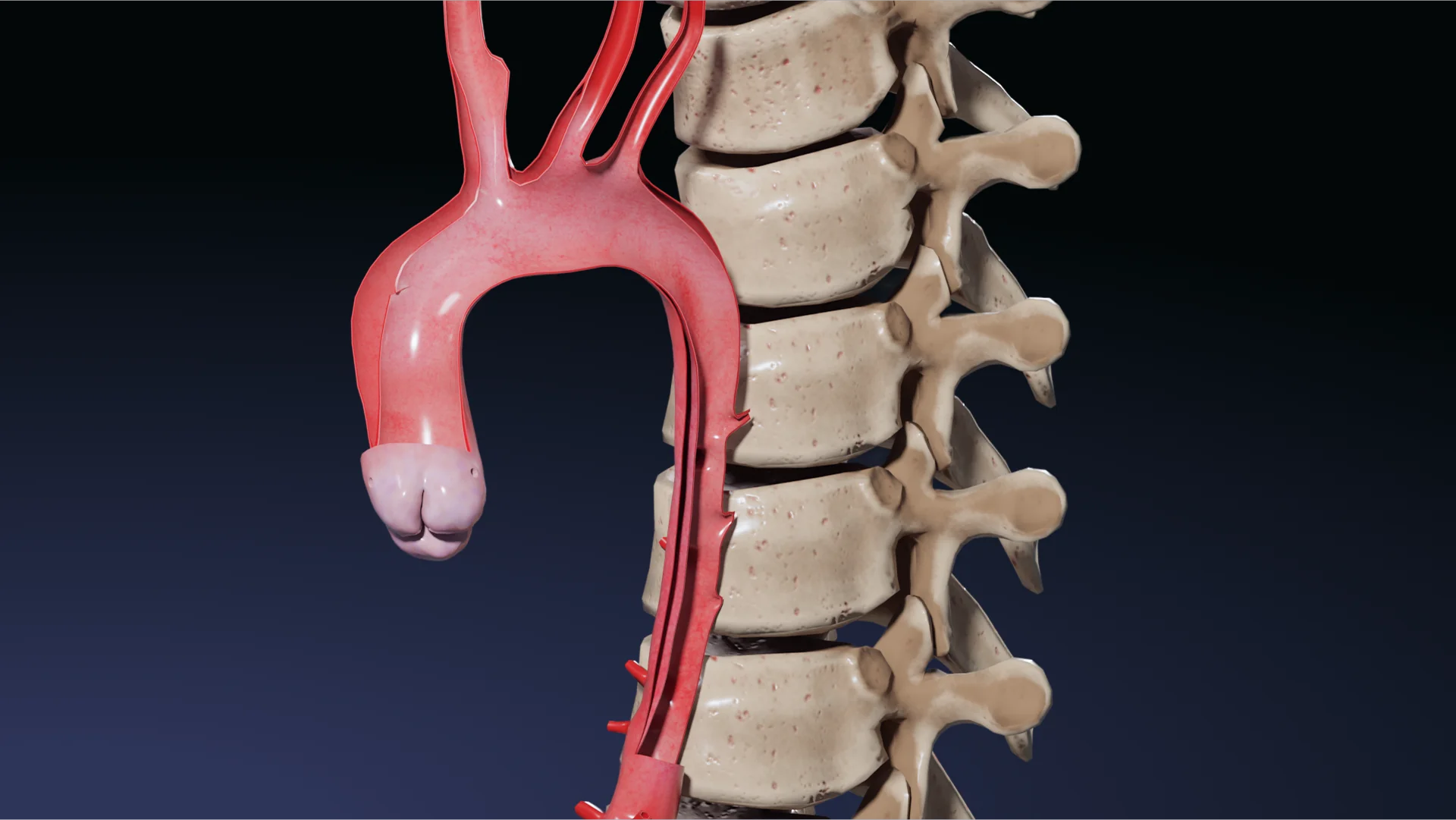 Dissection aortique type I 