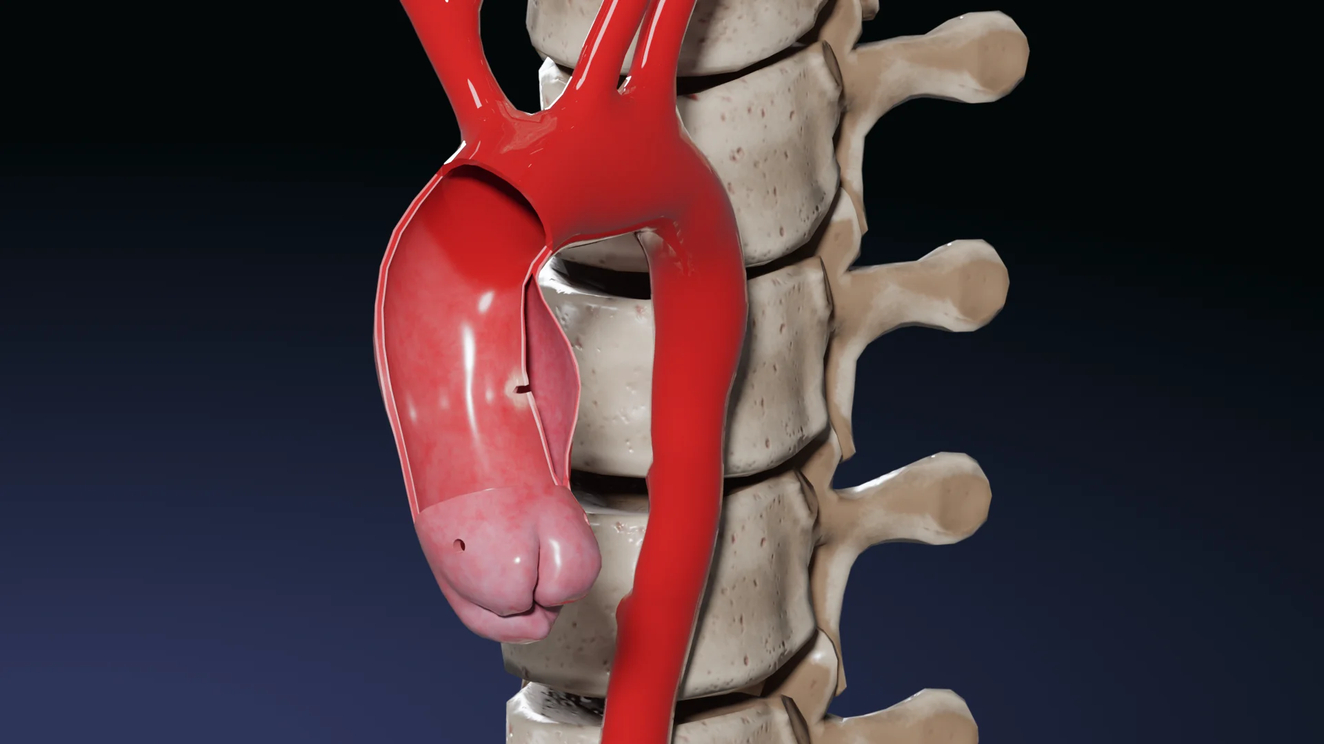 Dissection aortique type II