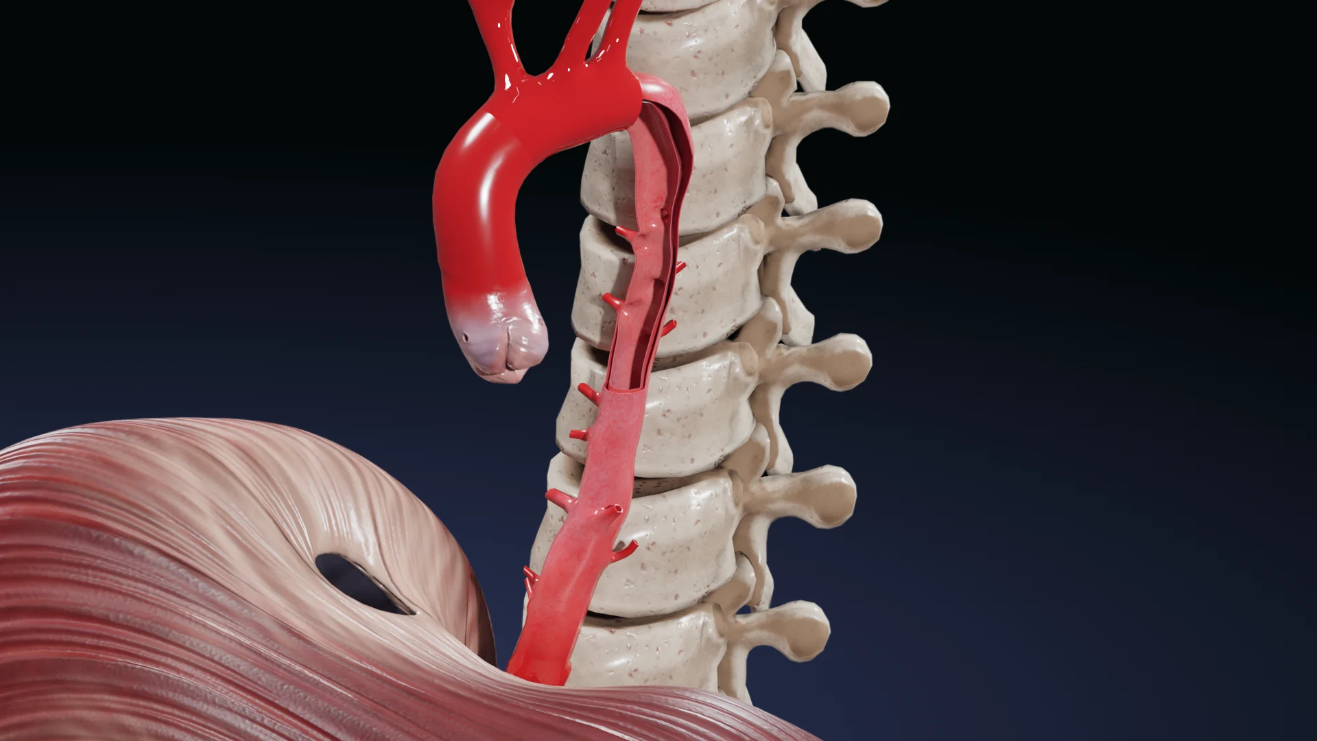 Dissection aortique type IIIa