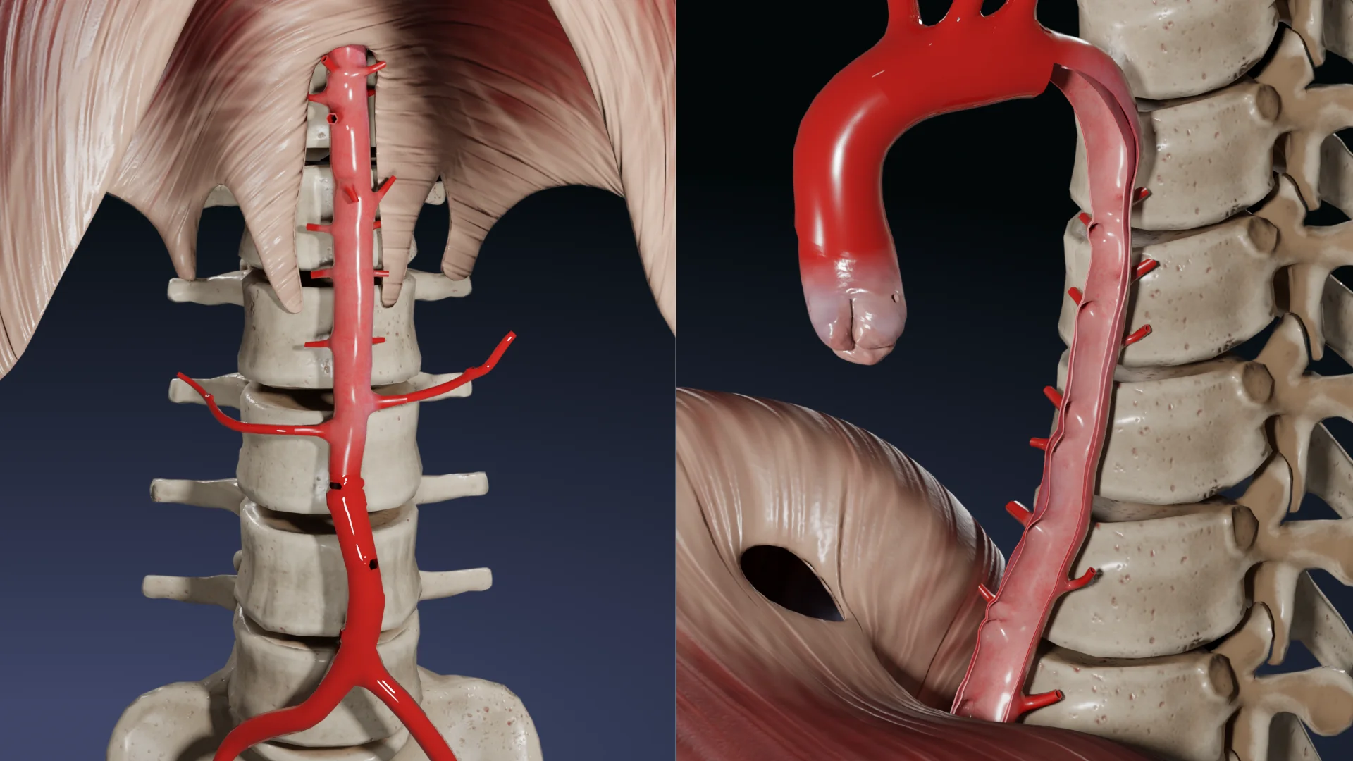 Dissection aortique type IIIb