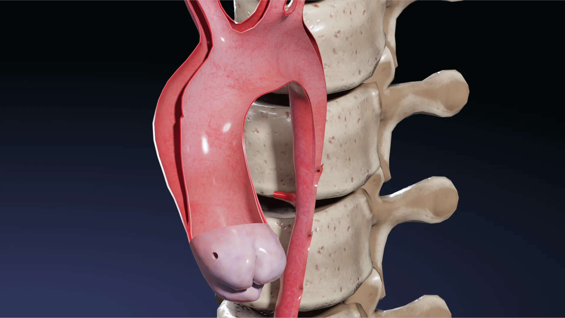 Dissection aortique : étiologie, pathogénie, classification, diagnostic et méthodes de traitement