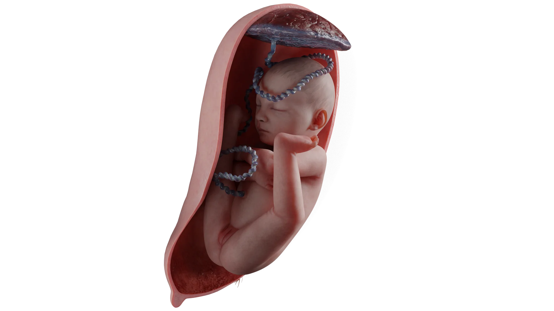 Breech presentation of the fetus