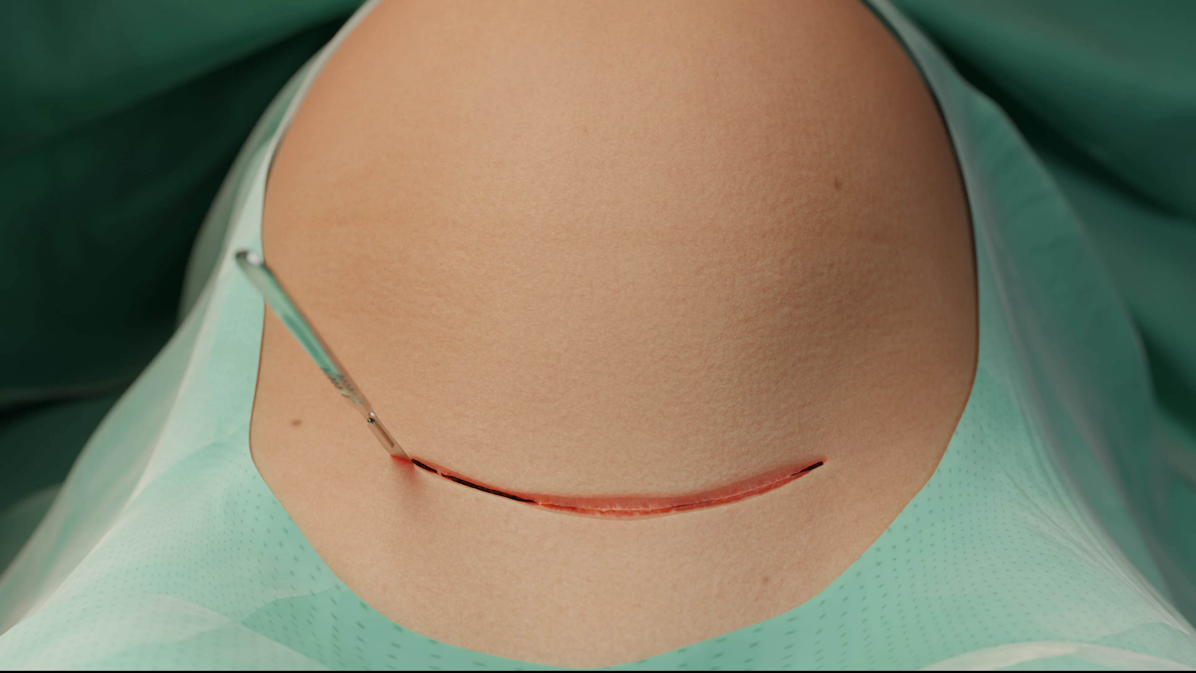 C-section: Indications, Preparation, Techniques, Postoperative Management