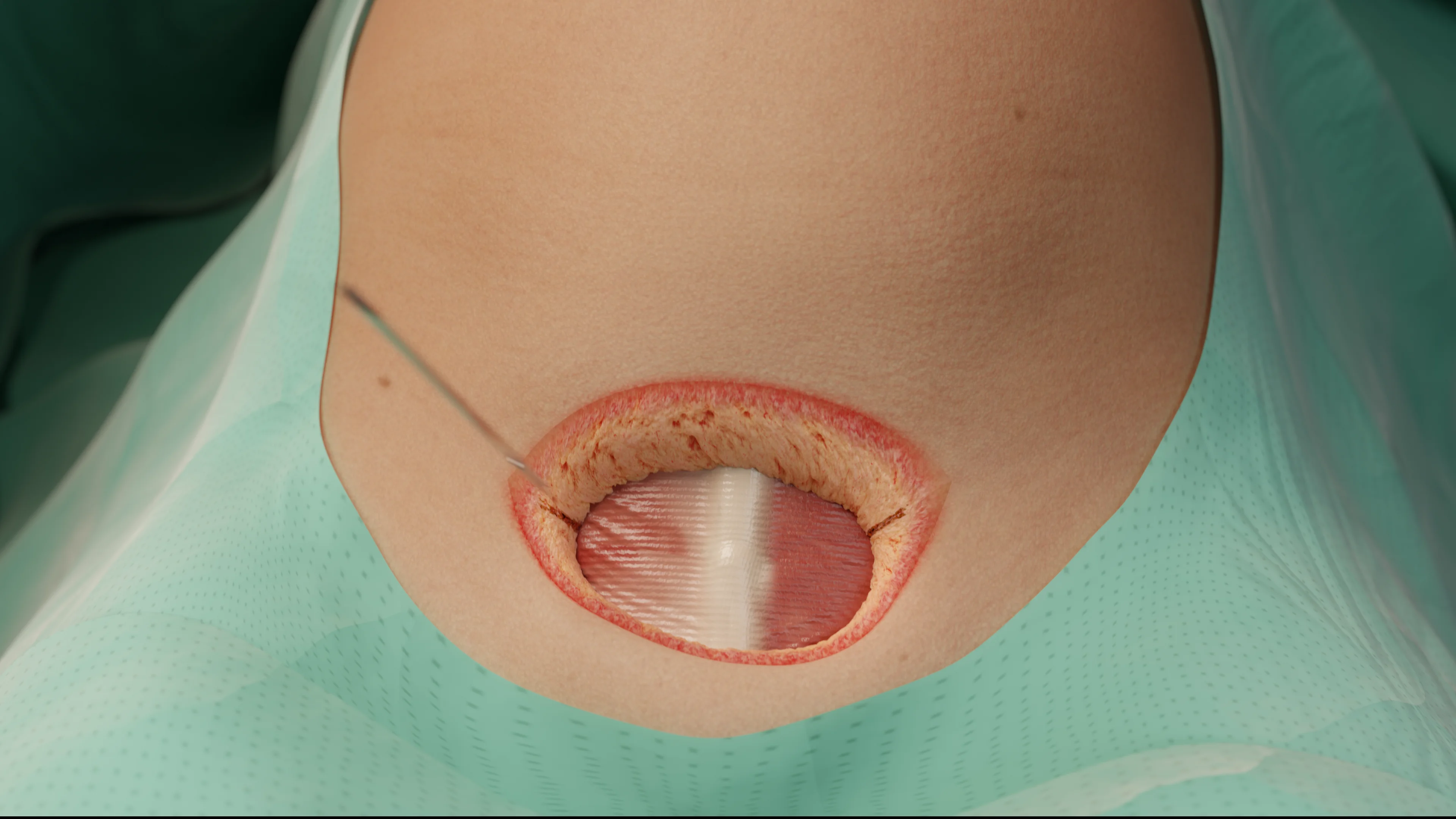 Incision du tissu adipeux sous-cutané