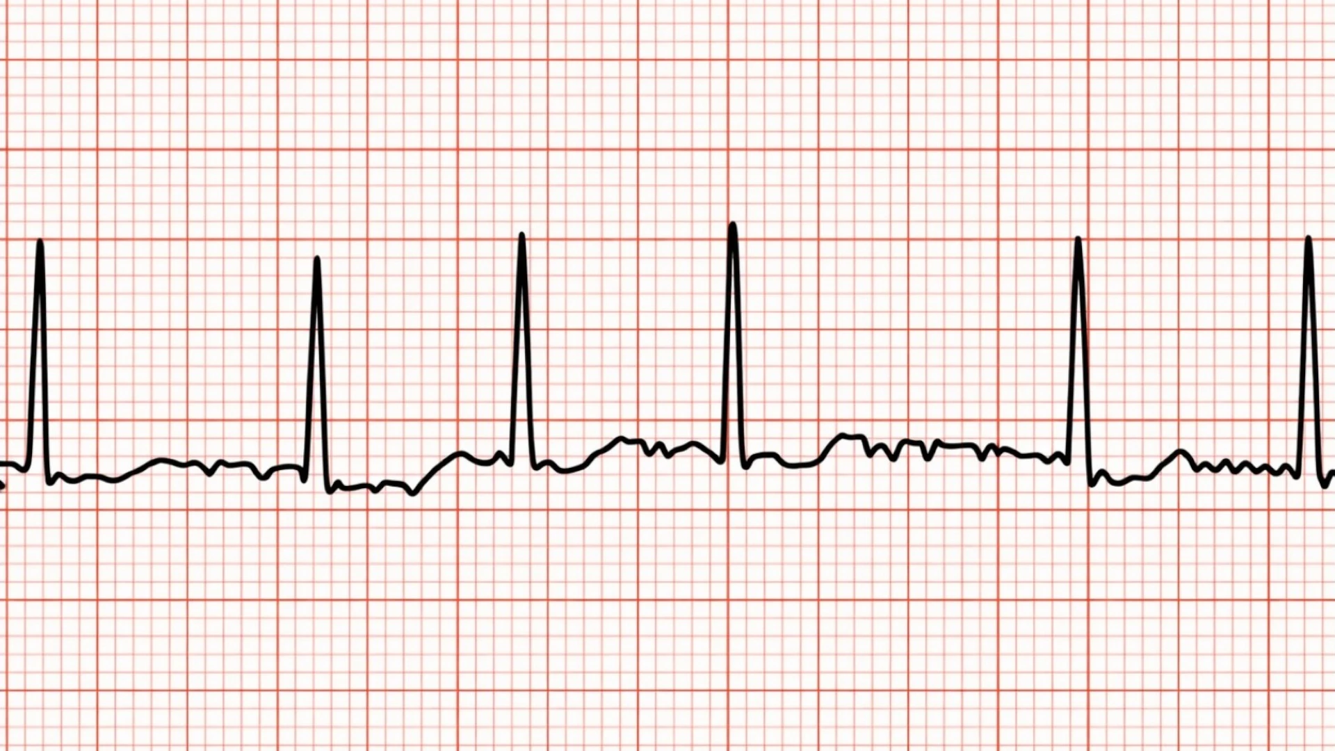 Пример фибрилляции предсердий на ЭКГ