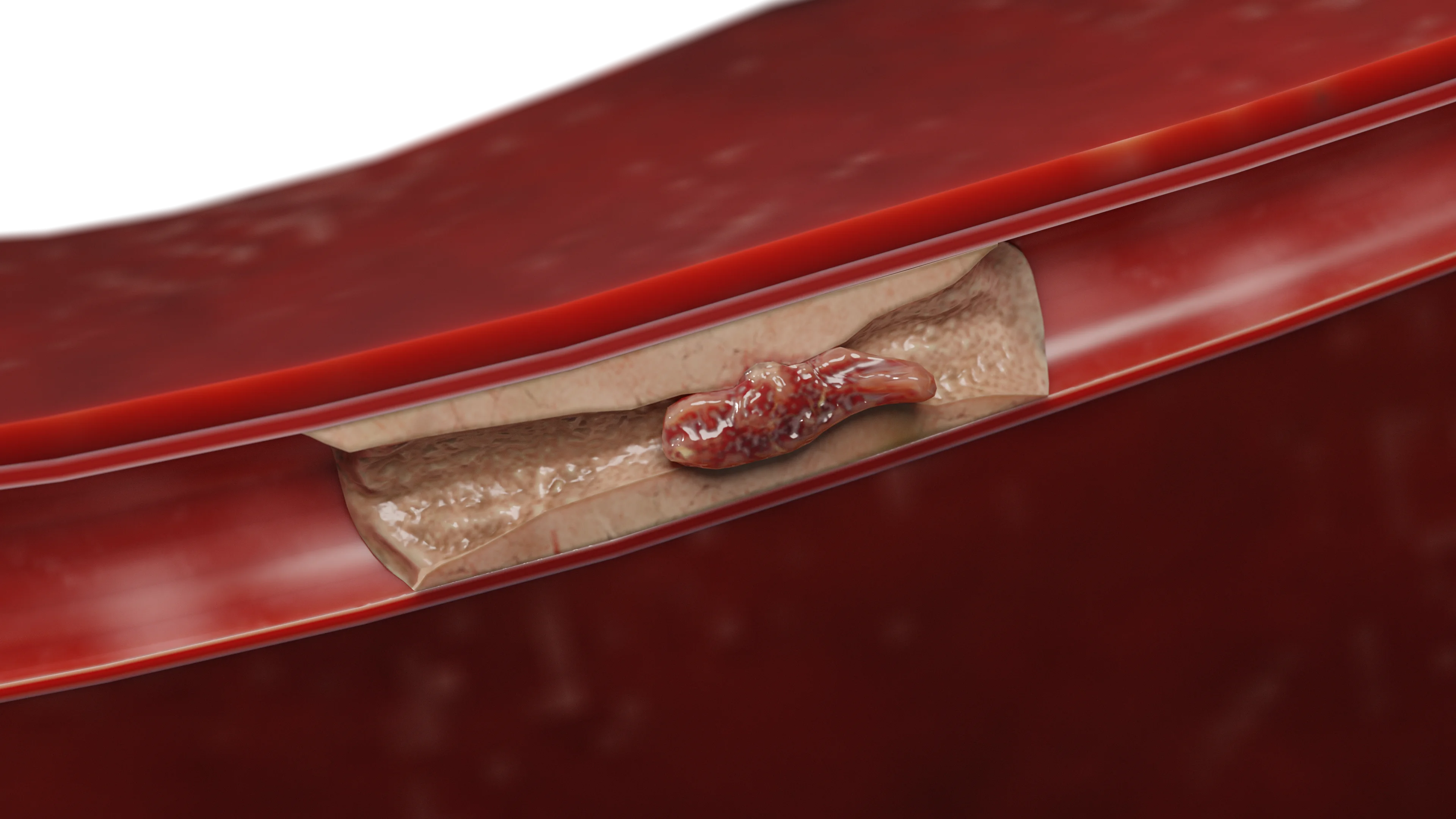 Thrombotic occlusion of the coronary artery due to critical narrowing by the atherosclerotic plaque