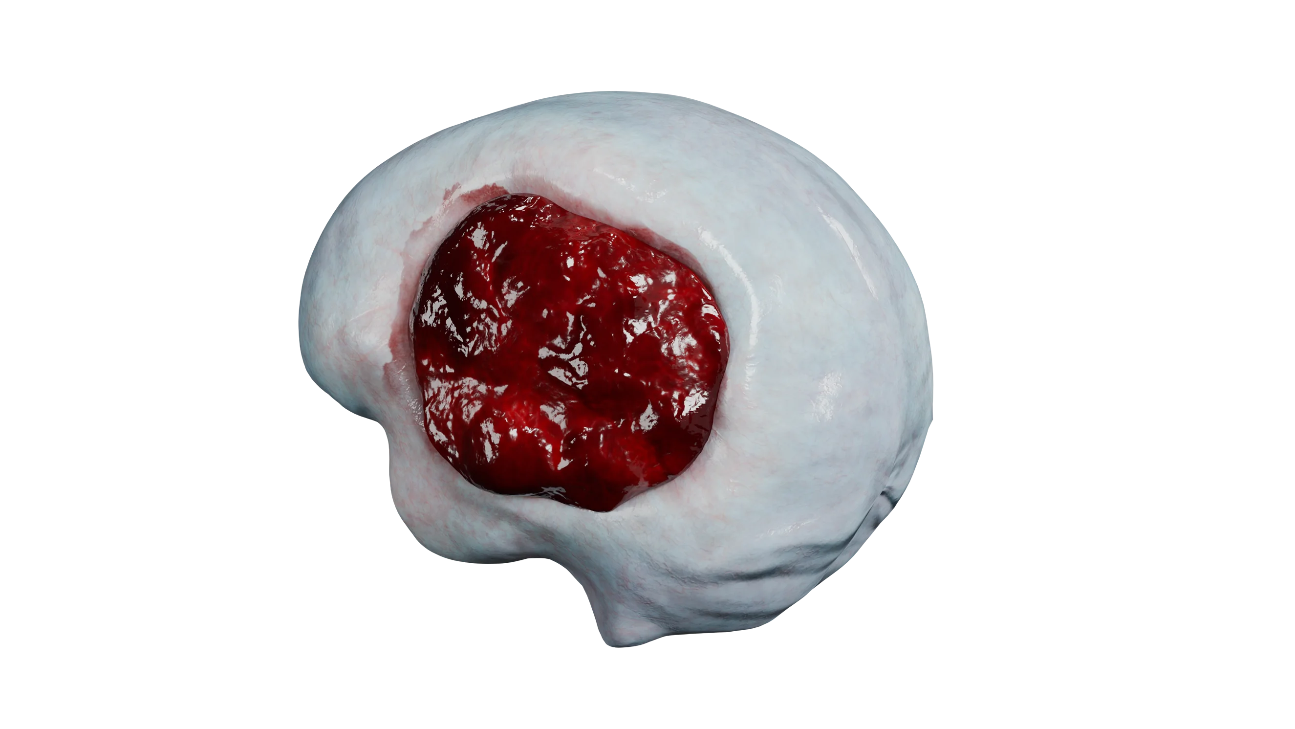 Akutes epidurales Hämatom basal-temporaler Lokalisation