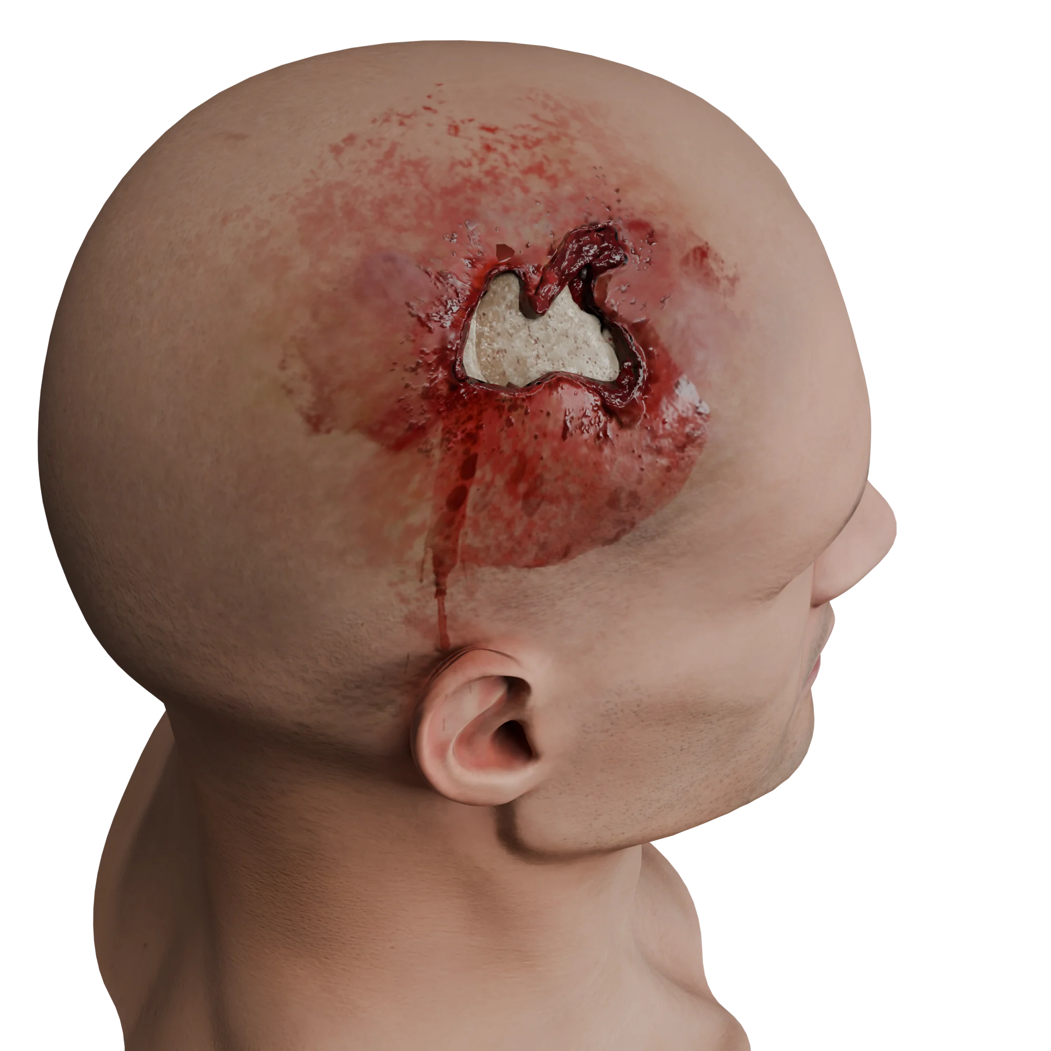 Schädel-Hirn-Trauma (CCI): Klassifizierung, Ätiologie, Symptome, Behandlung