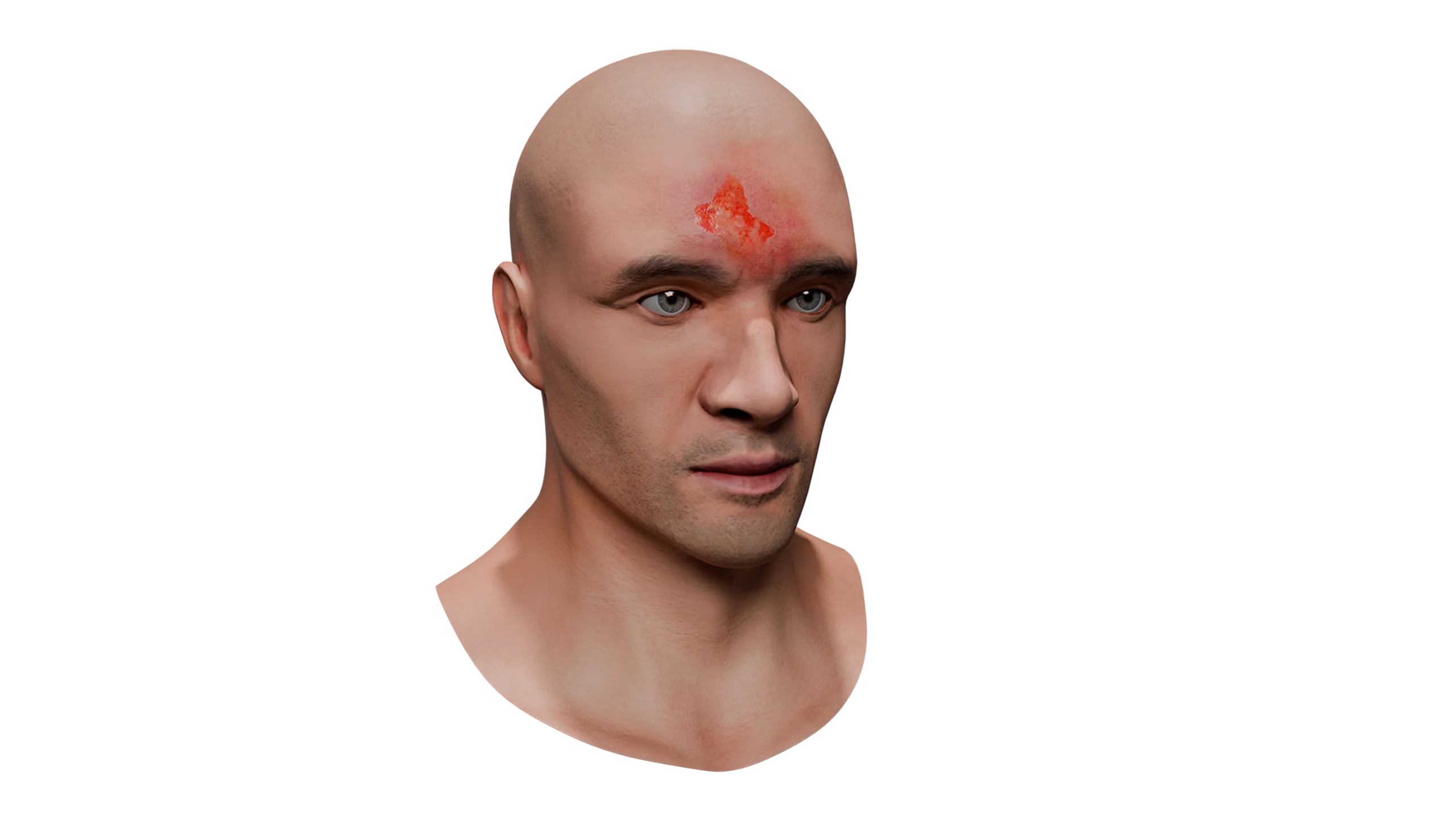 Soft Tissue Contusion of the Head