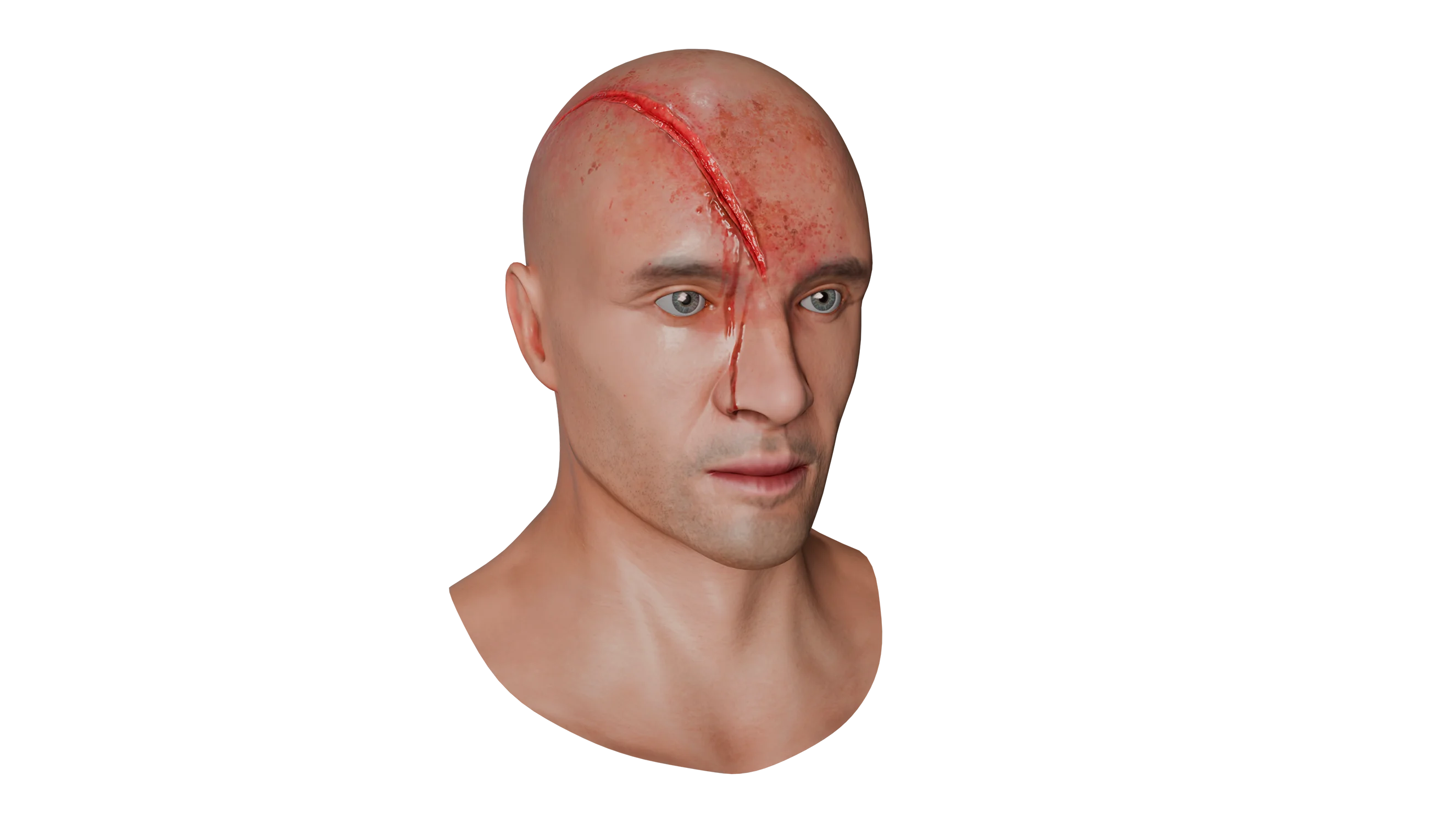 Scalp Wound Without Aponeurosis Damage