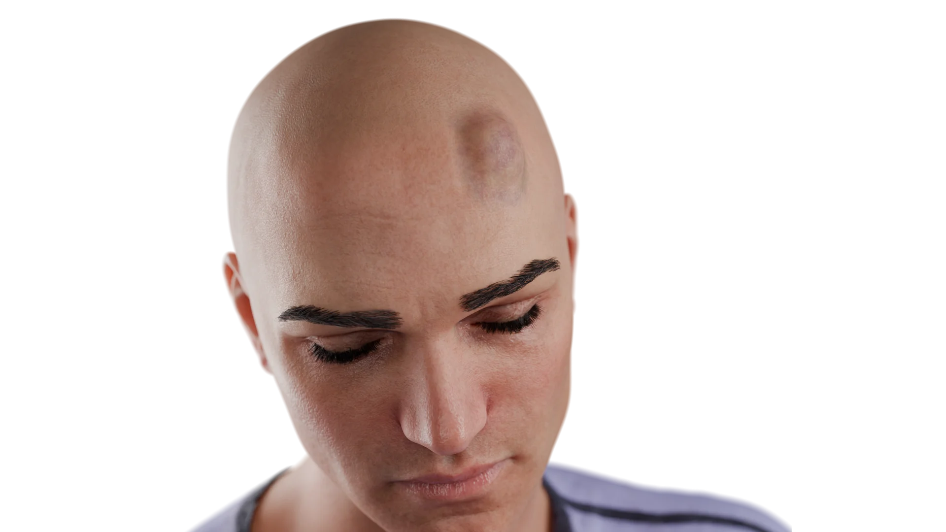 Subcutaneous Hematoma of Soft Tissues of the Head