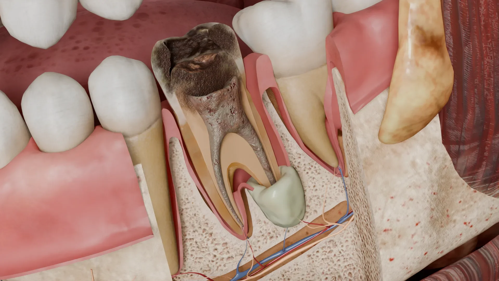 Abcès apical : causes et traitement