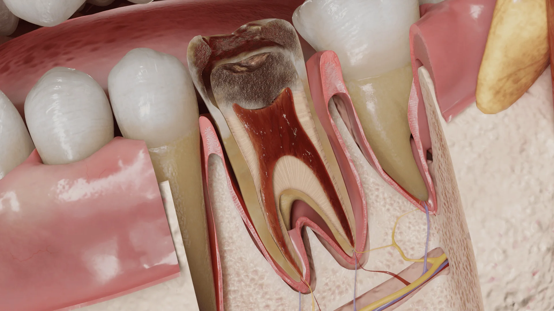 Pulp swelling and hyperemia in acute irreversible pulpitis