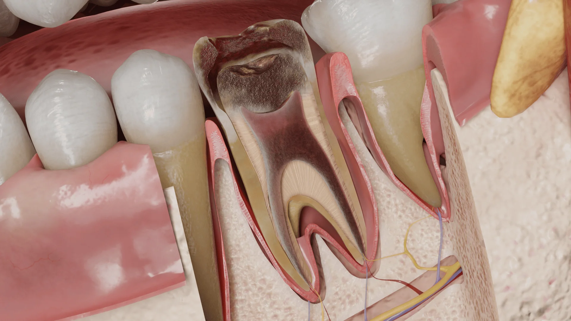 Replacement of pulp by scar tissue in chronic irreversible pulpitis