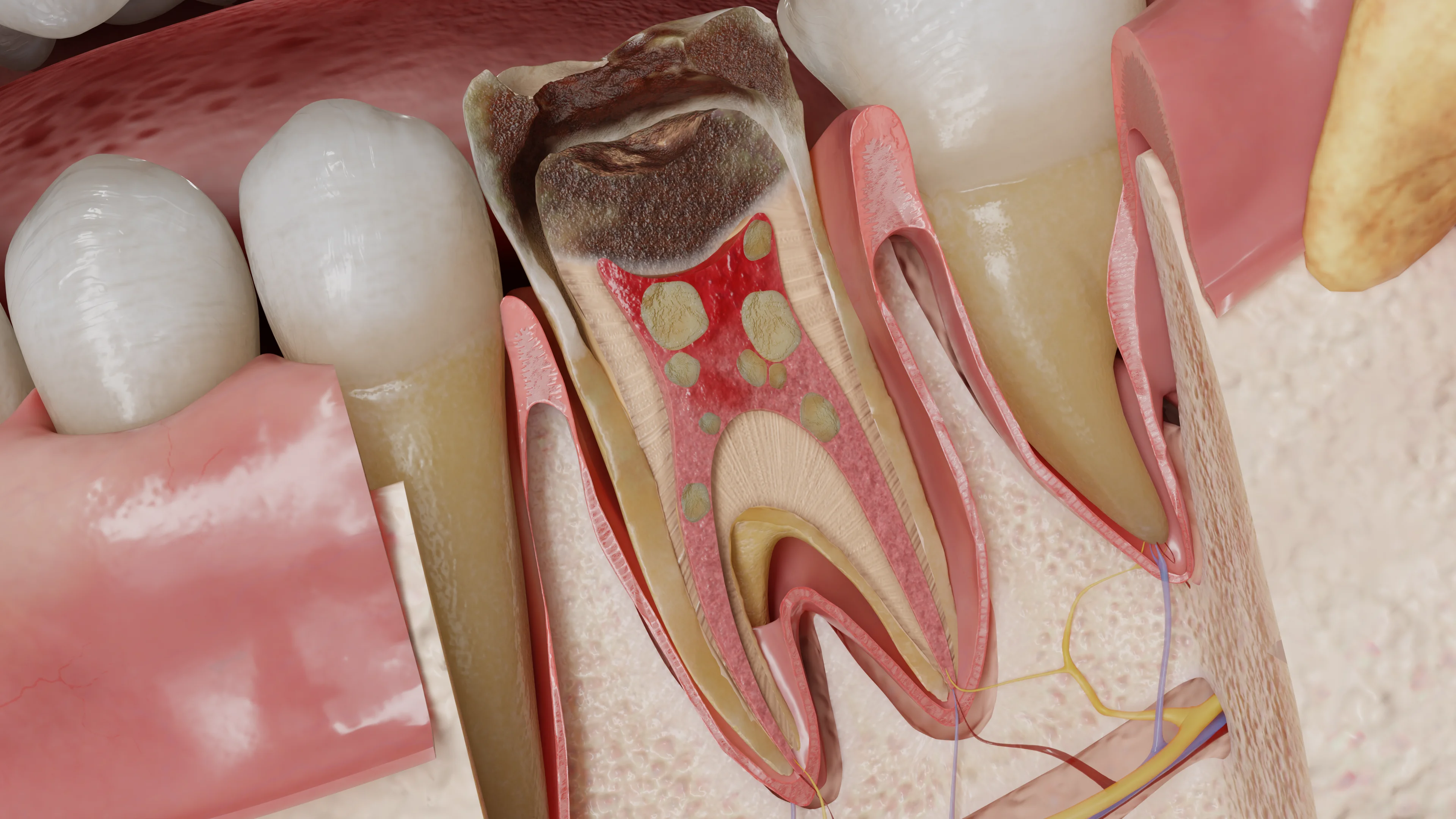 Патологические изменения пульпы зуба: гиперплазия, некроз и кальцификация