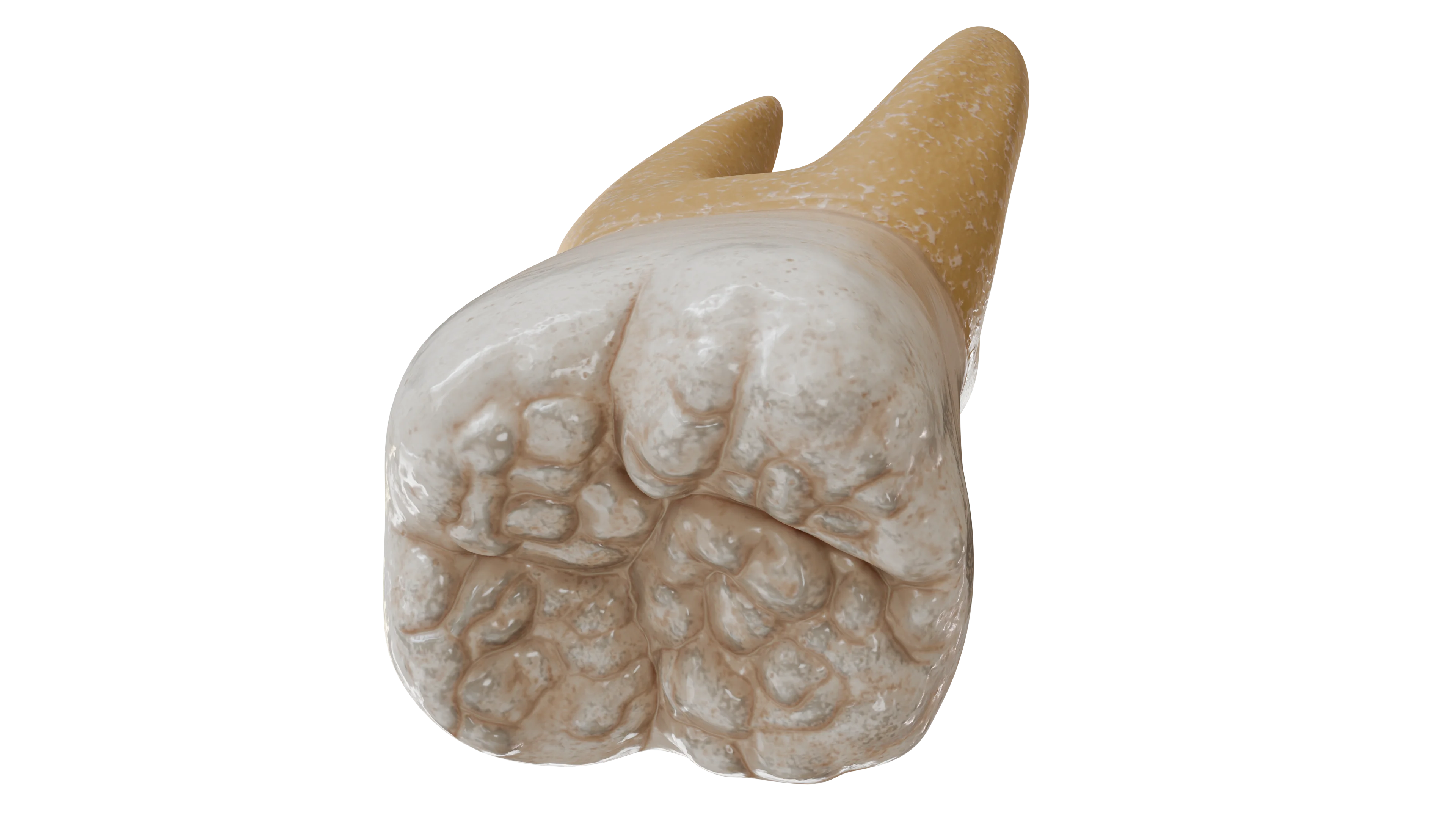 Специфические формы системной гипоплазии эмали (зубы Гетчинсона, Фурнье, Пфлюгера, «тутовые» моляры): причины, диагностика и лечение