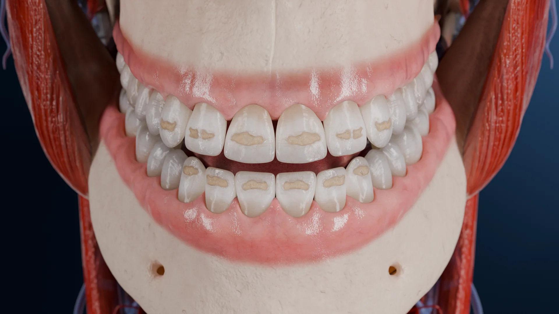 Cup-shaped form of systemic enamel hypoplasia