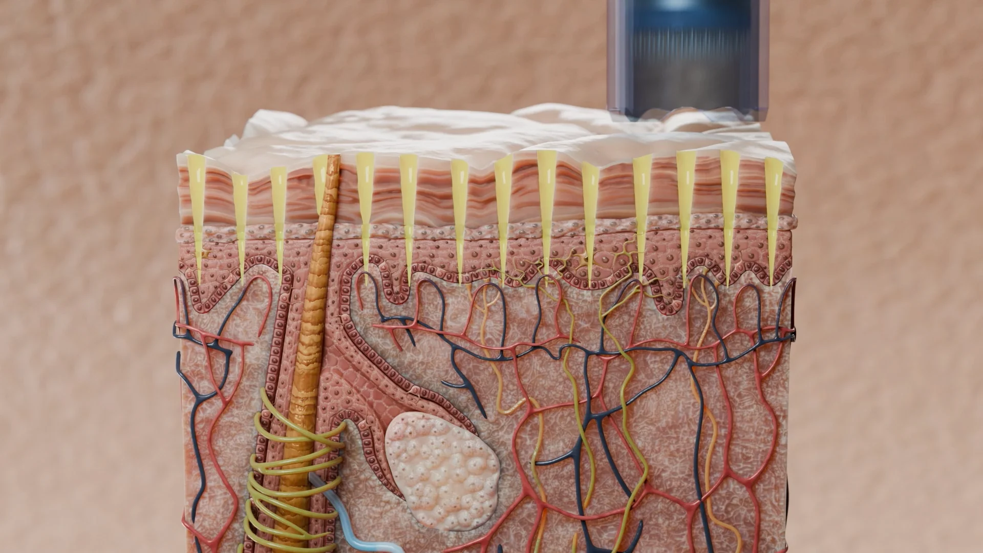 اختراق الإبر الدقيقة للجهاز في طبقات الجلد