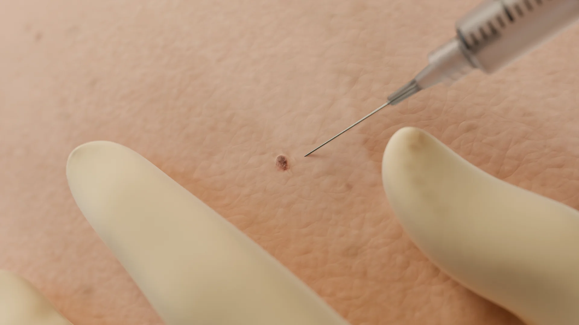 Местная анестезия