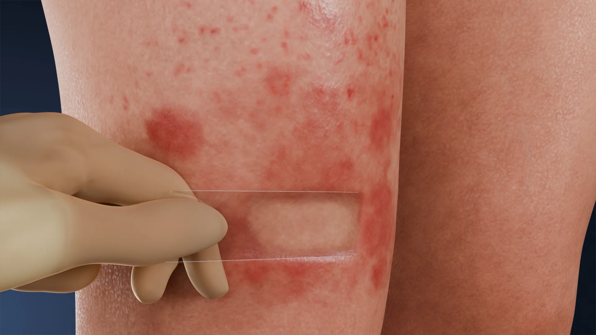 Diascopy in Dermatology: Mechanism of Action, Technique, and Differential Diagnosis of Skin Lesions